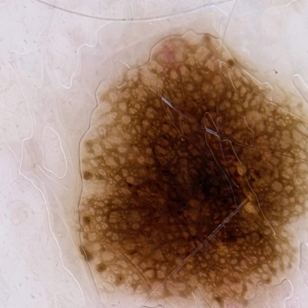 Dermoscopy close-up from Dr. Christopher’s library, illustrating globules