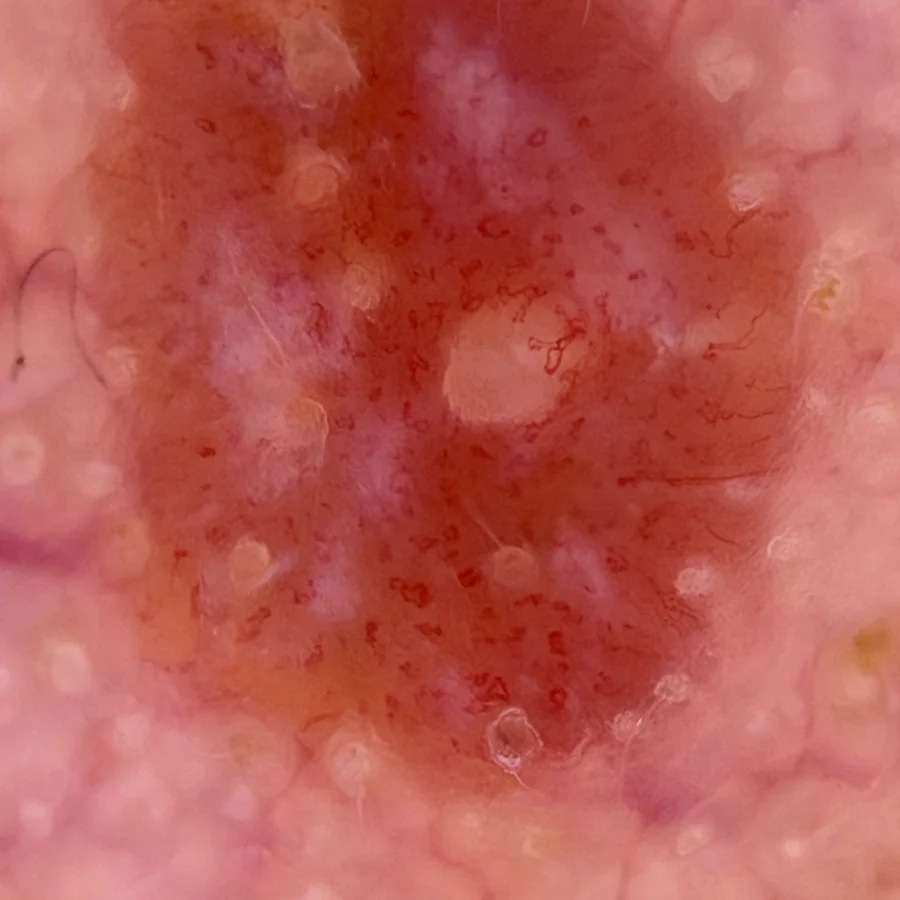 Dermoscopy close-up from Dr. Christopher’s library: a pink spot with dotted and linear blood vessels